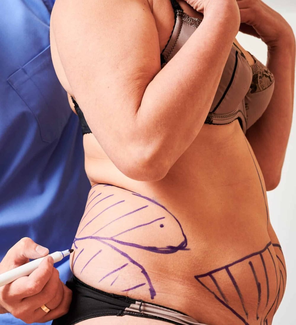 OUR signature Ultra Advanced Tummy Tuck (Front & Flanks)