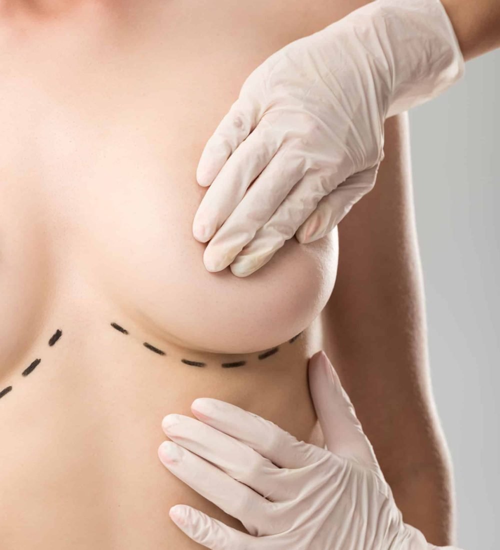 Breast Augmentation with Implants